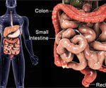 Inflammatory Bowel Disease May Raise Cancer Risk in Kids