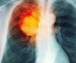 Radiation and Chemotherapy Together Boost Lung Cancer Survival