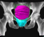 What Is Papillary Urothelial Carcinoma?