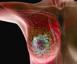 Risk of Breast Cancer’s Return Can Linger for Decades