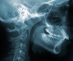 Gene Therapy May Fight Brain Cancer’s Return