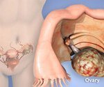 Know the Signs of Ovarian Cancer and Your Risks