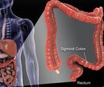 Don’t Fret Delays in Treating Colon Cancer, Study Suggests
