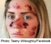 Woman’s Selfie of Skin Cancer Went Viral, Sparked Awareness