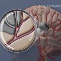 Short kids may have higher future stroke risk