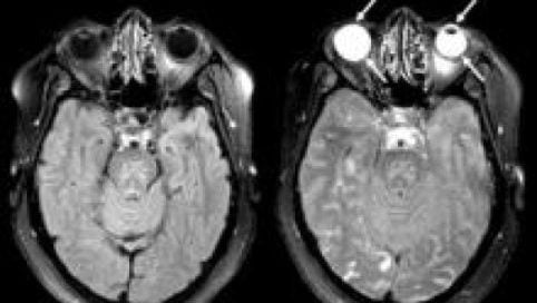 Eye could provide “window to the brain” after stroke