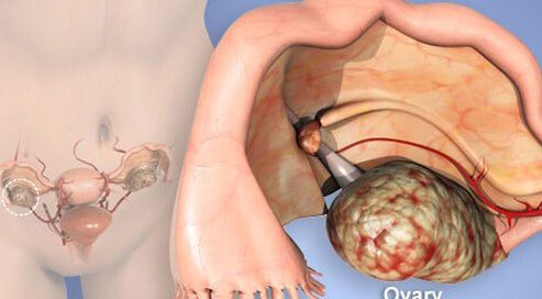 CA 125 Blood Test, Normal Ranges & Causes of Elevated Results