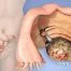 CA 125 Blood Test, Normal Ranges & Causes of Elevated Results