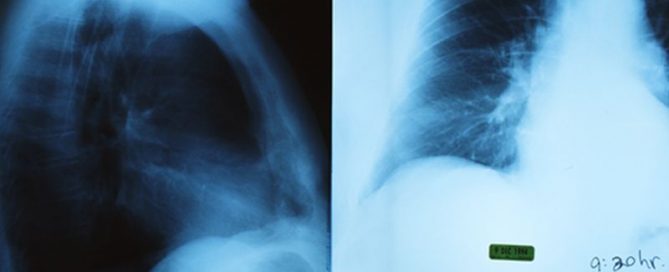 Positioning During Cancer Radiation May Be Key to Heart Risks