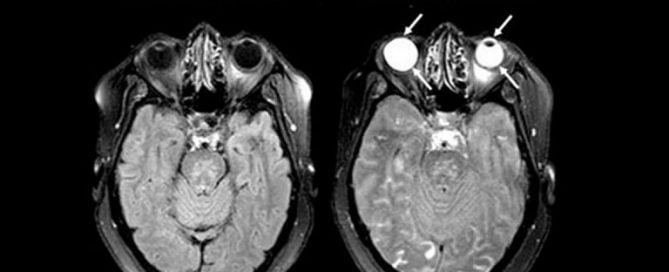 From the lab – Eyes May be ‘Windows to the Brain’ in Stroke Patients