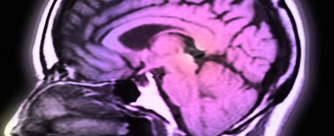 Immune-Based Therapy May Help When Melanoma Spreads to Brain