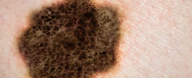 Frequent Skin Cancers May Signal Risk of Other Cancers, Too