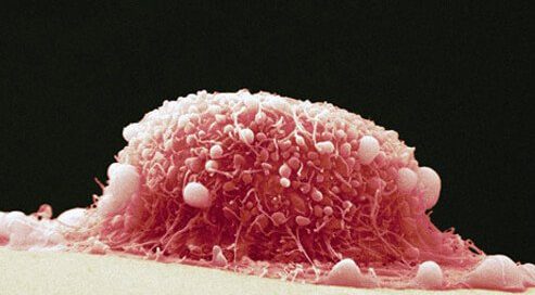 Cervical Cancer Symptoms, Causes, Stages, and Survival Rates