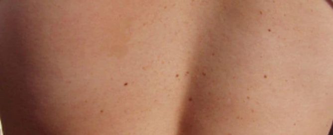 Global Melanoma Deaths Up Among Men, But Not Women