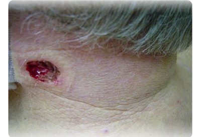 Mohs Surgery Recovery, Aftercare Instructions, Cost & Pictures