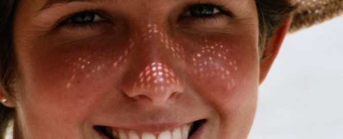 Laser-Based Test Hunts Stray Melanoma Cells in Blood