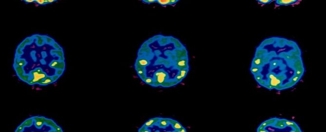Better Treatments Needed to Boost Brain Cancer Survival: Study