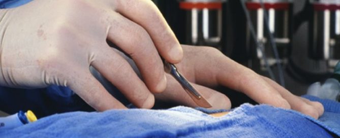 New Test Can Pinpoint Which Pancreatic Cysts Might Turn Cancerous