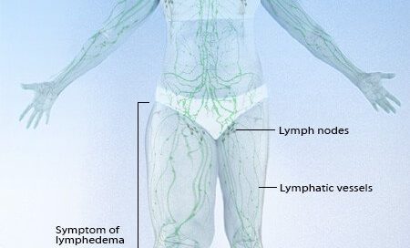 What Is Lymphedema? Treatment, Therapy, Causes, Symptoms, Pictures