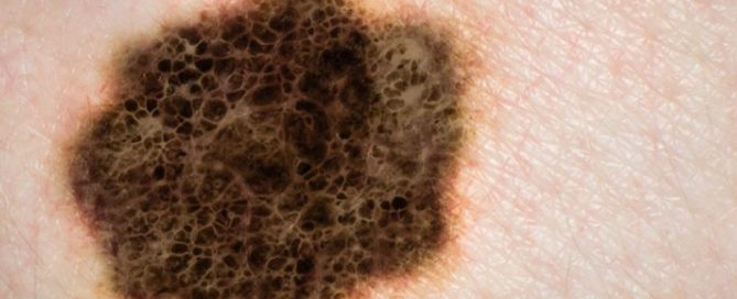 Head, Neck Melanomas Show Alarming Rise in Young Americans