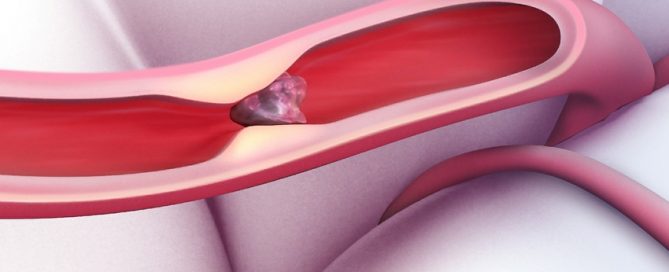 Weight-reduction surgery may prevent strokes, lengthen lives