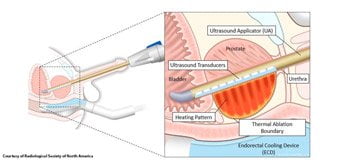Using Sound Waves to Destroy Prostate Cancer