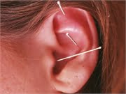 Acupuncture May Ease a Common Side Effect of Cancer Treatment