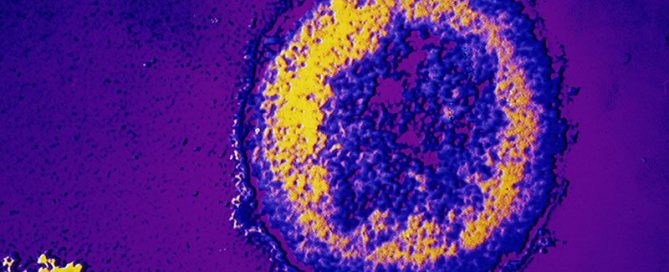 Targeted Ultrasound Destroys Cancer Without Harming Healthy Cells: Study