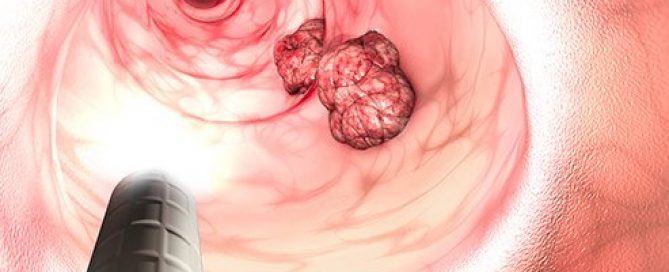 Anal Cancer Symptoms, Signs, Causes & Risk Factors