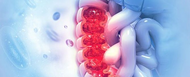 Facts You Should Know About Anal Cancer
