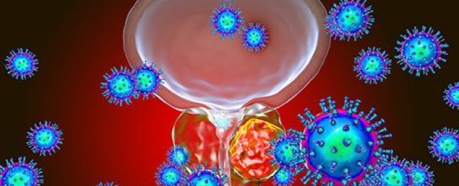 How Is Prostate Cancer Diagnosed? PSA, Digital Rectal Exam & Biopsy