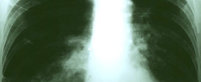 Minorities Less Likely to Get Recommended Lung Cancer Imaging