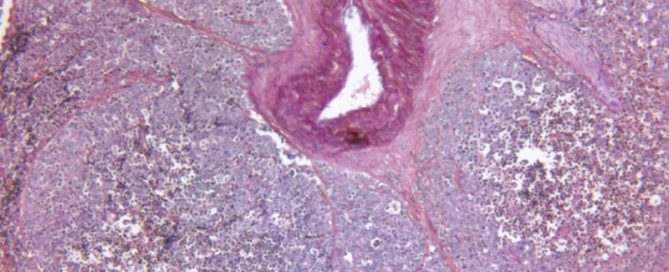 Prostate Cancer Leaves Detectable ‘Fingerprint’ in Blood: Study