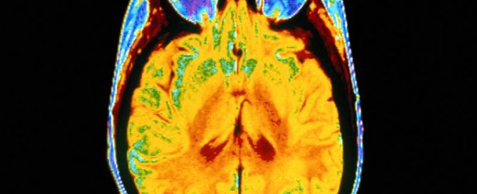 Could AI Help Doctors Map Out Treatments for Brain Cancers?