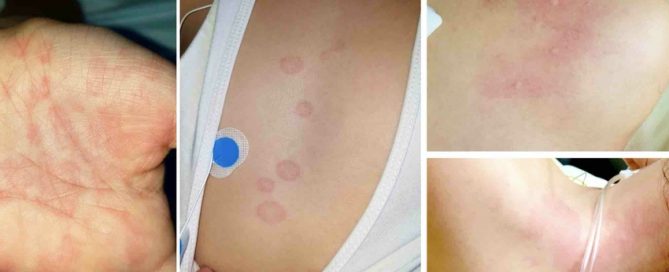 Immunotherapy, steroids had positive outcomes in children with COVID-related multi-system inflammatory syndrome