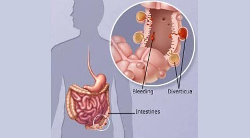 Why Is Hartmann’s Procedure Necessary? For Diverticulitis