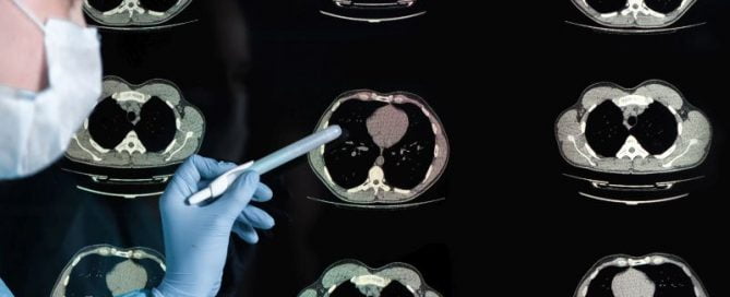 New Guidelines Could Double Number Eligible for Lung Cancer Screening