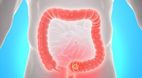 What Does Colon Cancer Poop Look Like?