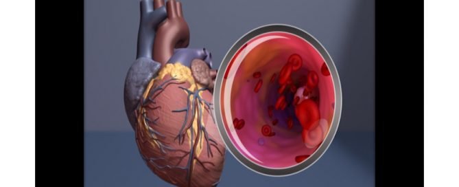 Combo therapy may prevent blood vessel complications in children with Kawasaki disease