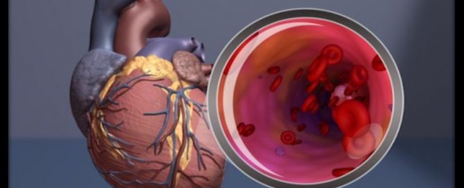 New abdominal aortic aneurysm genes identified, could help pinpoint those at risk