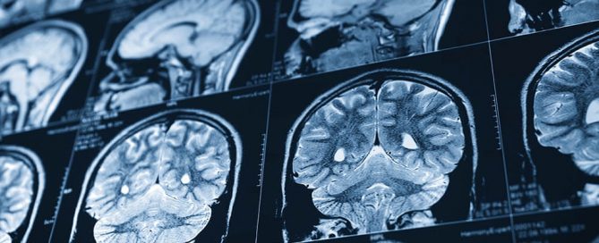 Brain imaging, telehealth studies promise better stroke prevention and recovery