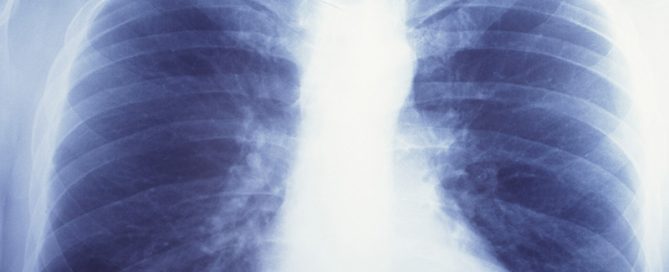 Immunotherapy Drug Boosts Survival for Lung Cancer Patients