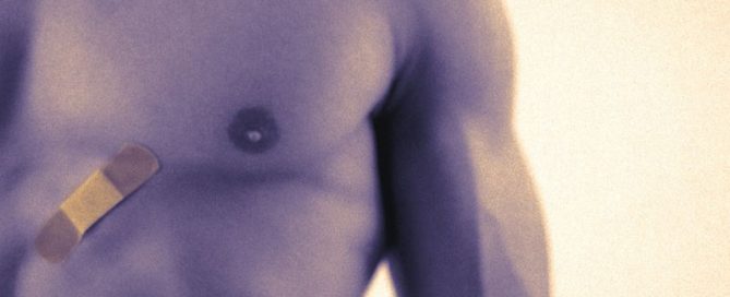 Many Male Breast Cancers Diagnosed Late, and Delays Can Be Lethal