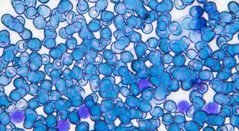 What Is B-Cell Acute Lymphoblastic Leukemia (B-cell ALL)?