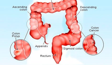 Erbitux (cetuximab) for Colorectal Cancer: Side Effects & Warnings