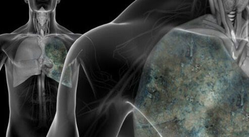 Pandemic Closures, Fears Keep Patients From Lung Cancer Screening