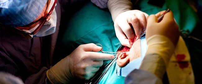 What Are the Four Types of Neck Dissection? Purpose
