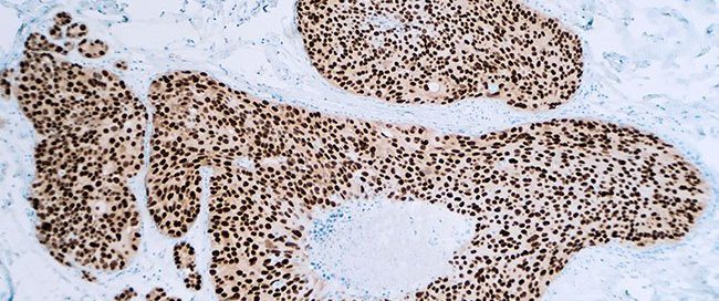 Role of Estrogen Receptors in Breast Cancer: Testing and Results