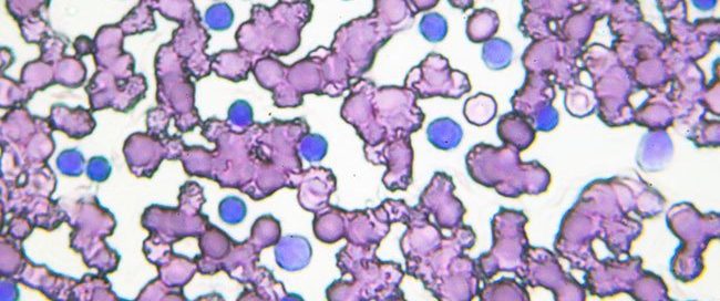 What Are the Stages of Chronic Lymphocytic Leukemia?