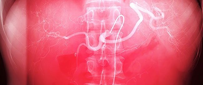 What Are the Side Effects of Embolization? Procedure, Benefits & Risks